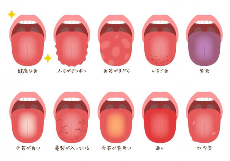 舌 の むくみ 歯形